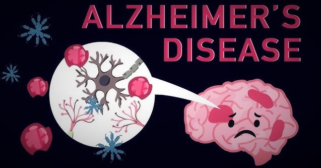 Alzheimer’s facts